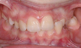 ortodonzia precoce, Dr. Francesco Pedetta
