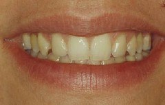 faccette estetiche, estetica del sorriso, ortodonzia preprotesica