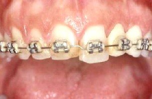 ortodonzia preprotesica, filo dritto, straight wire, allineamento denti