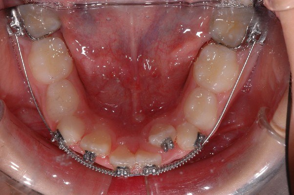 apparecchio fisso, archi preformati, molle per il recupero dello spazio, terapia non estrattiva