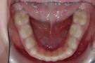 terapia intercettiva, allineamento in dentizione mista, forma dell'arcata naturale, apparecchio fisso