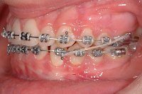 Ortodonzia tradizionale