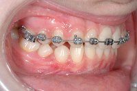 Ortodonzia tradizionale