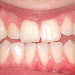 sorriso 14a