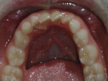 affollamento dentale, estrazioni