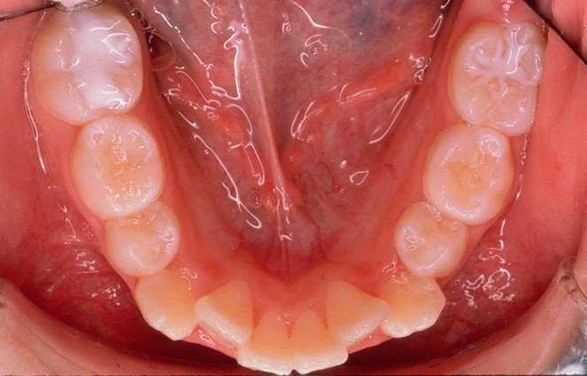 affollamento dentario