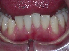 ortodonzia parodontale, affollamento incisivo, senza estrazioni