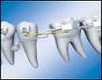 L'ancoraggio in ortodonzia