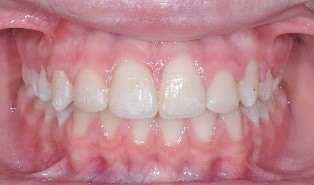 ortodonzia precoce, Dr. Francesco Pedetta