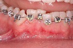 affollamento dentario, terapia senza estrazioni, brackets 