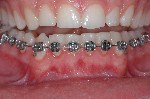 arco filo dritto, brackets, apparecchio ortodontico fisso