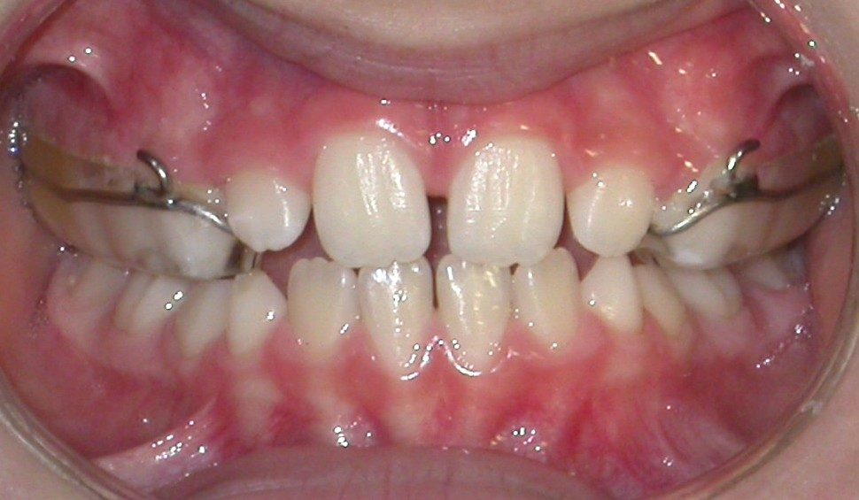 espansore del palato con doccette in resina, bonded RPE