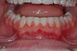 trattamento ortodontico senza estrazioni, allineamento denti