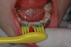 tecnica di spazzolamento, apparecchio ortodontico, brakets, igiene