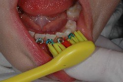 tecnica di spazzolamento, apparecchio ortodontico, brakets, igiene