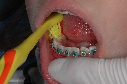 tecnica di spazzolamento, apparecchio ortodontico, brakets, igiene