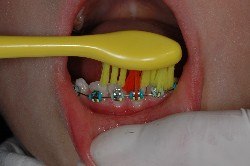 tecnica di spazzolamento, apparecchio ortodontico, brakets, igiene