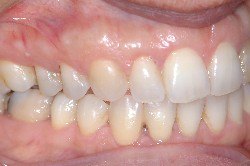 invisalign, trattamento ortodontico invisibile