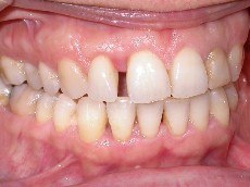 invisalign, terpia ortodontica invisibile