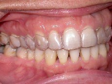 invisalign, mascherine trasparenti