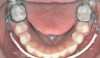Lip bumper