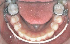 lip bumper, terapia funzionale