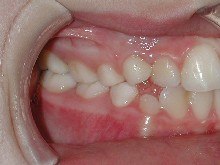 malocclusione di prima classe, affollamento dentale, trattamento precoce non estrattivo