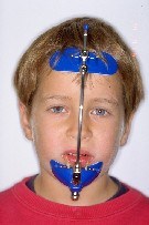 maschera facciale, di Petit, di Delaire, protrazione mascellare, crescita mandibolare