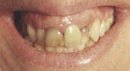 ortodonzia preprotesica, protesi dentale, corone, sorriso gengivale
