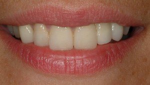 agenesie dei laterali, faccette estetiche