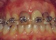 apparecchio ortodontico fisso, filo dritto, raddrizzamento denti, preprotesica ortodonzia