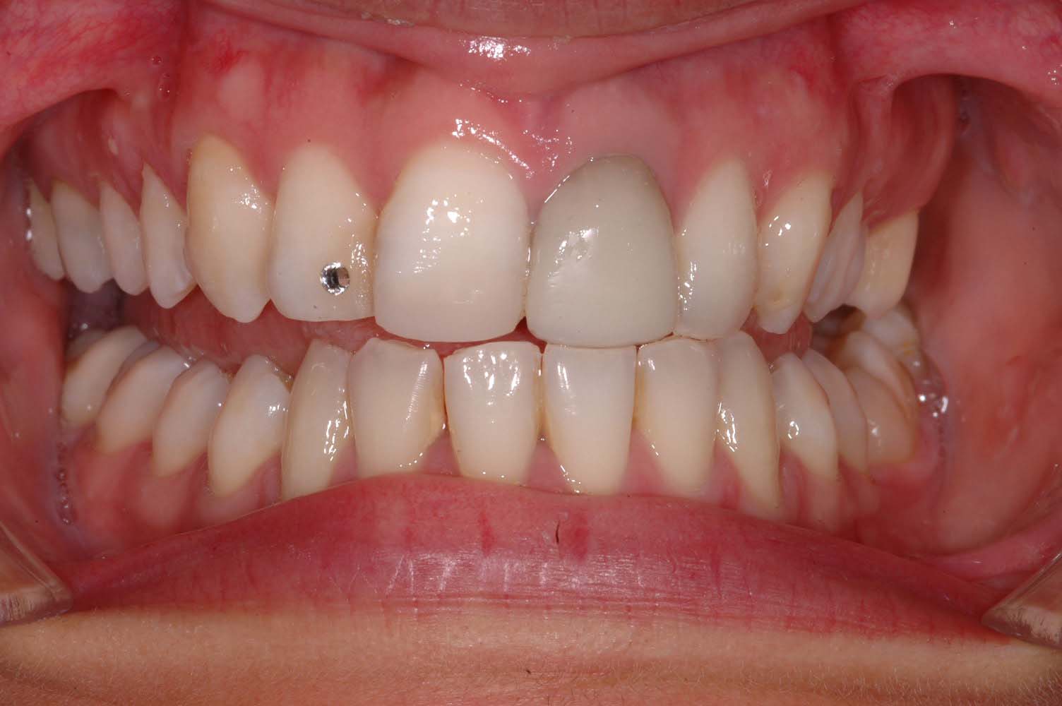 ortodonzia, apparecchio per i denti