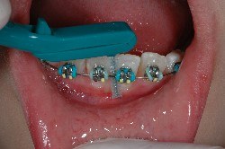 tecnica di spazzolamento, scovolino, apparecchio ortodontico, brakets, igiene