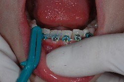 tecnica di spazzolamento, scovolino, apparecchio ortodontico, brakets, igiene