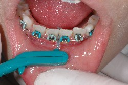 tecnica di spazzolamento, scovolino, apparecchio ortodontico, brakets, igiene