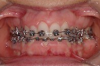 self ligating, straight wire