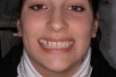 apparecchio in ceramica, estetico, esthetic brackets