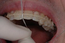 filo interdentale, tecnica di spazzolamento, scovolino, apparecchio ortodontico, brakets, igiene