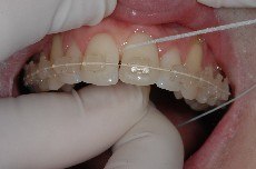 filo interdentale, tecnica di spazzolamento, scovolino, apparecchio ortodontico, brakets, igiene